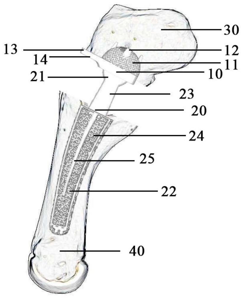 一种腕掌关节重建假体